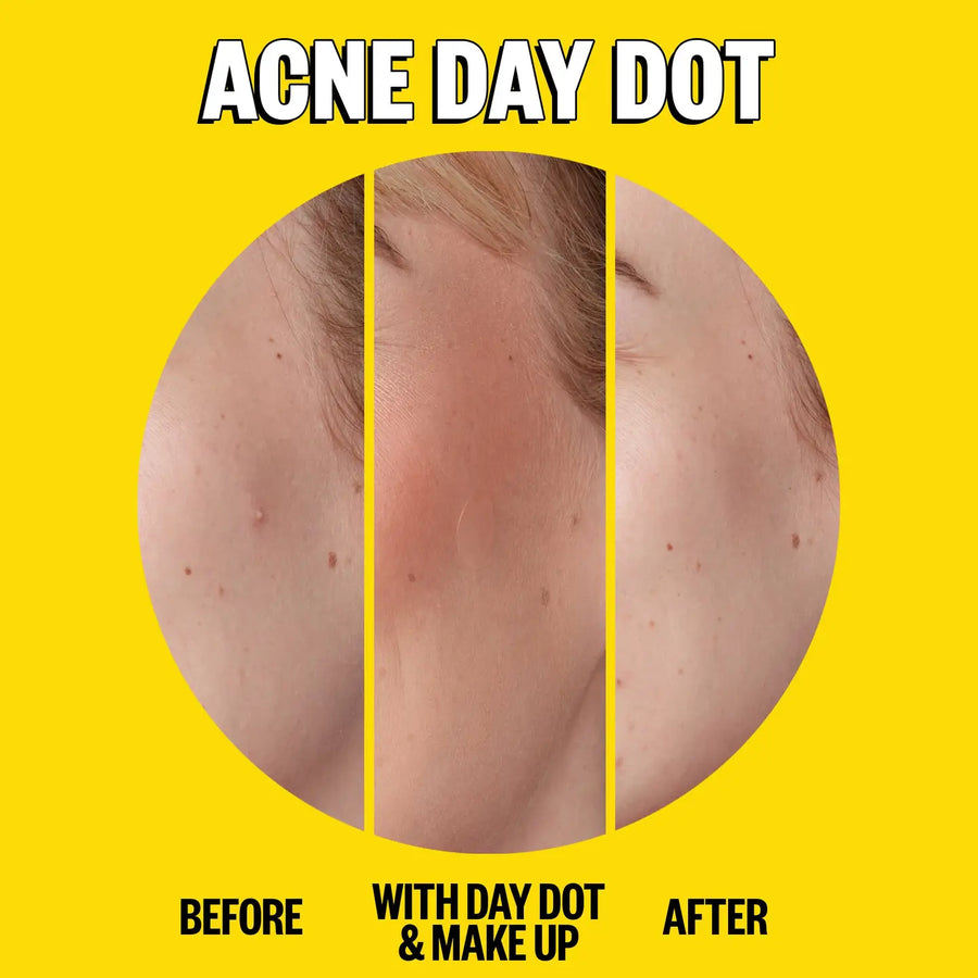 Acne Day & Night Duo